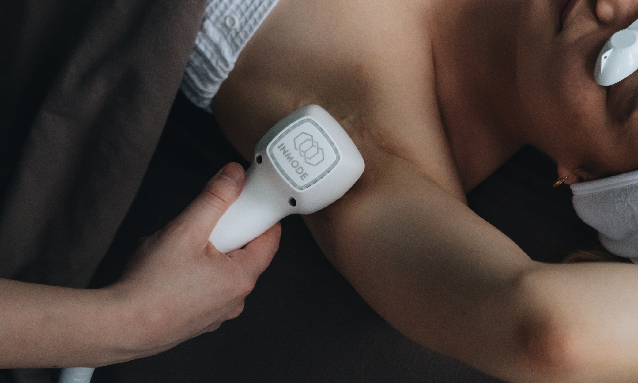 5 Things To Know Before Laser Hair Removal