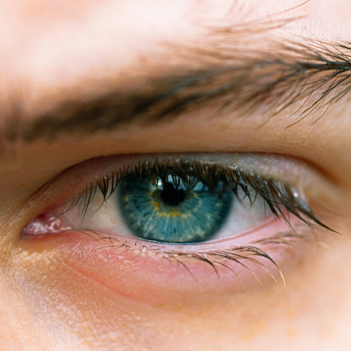 Ocular Rosacea: When Rosacea Affects the Eyes