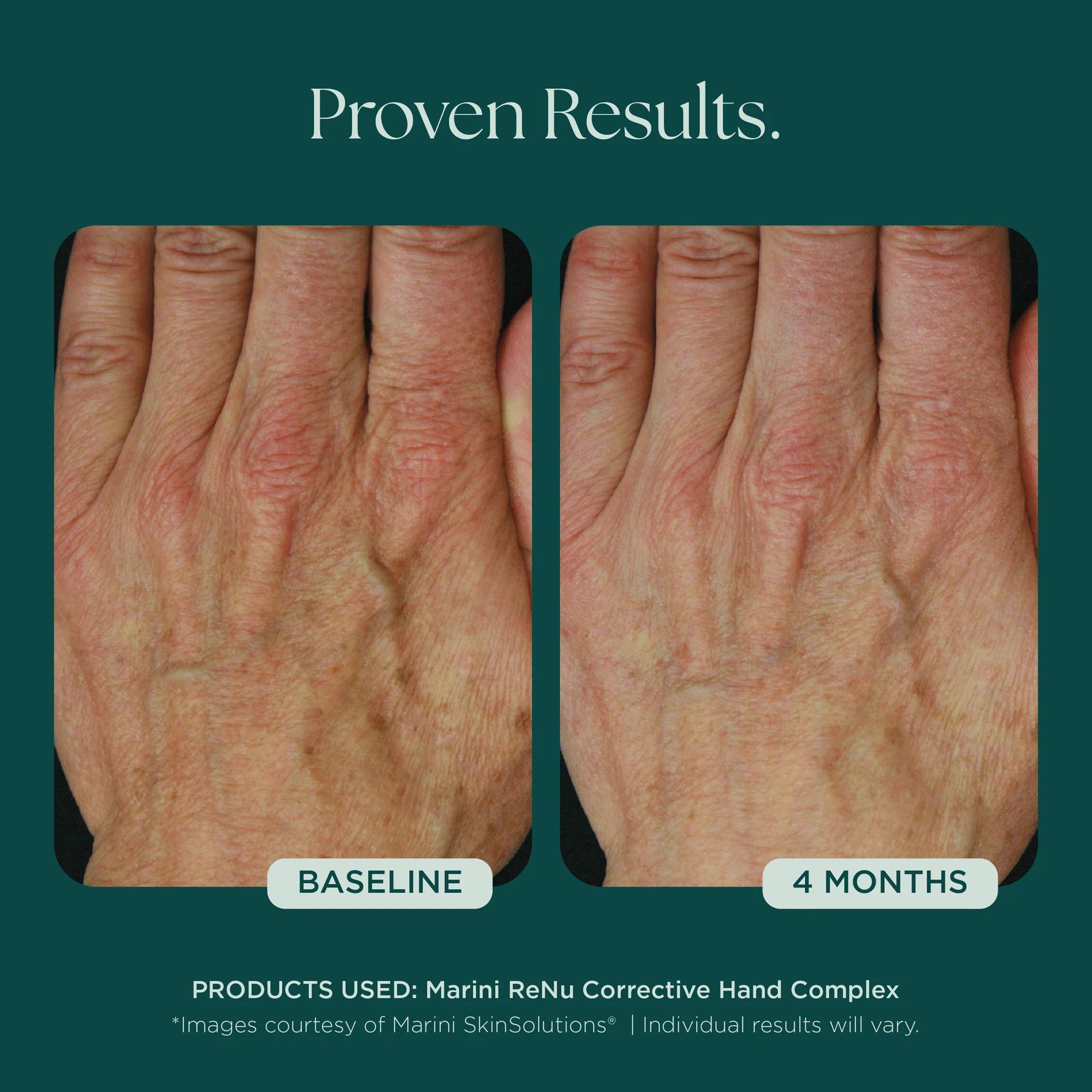 ReNu Corrective Hand Complex