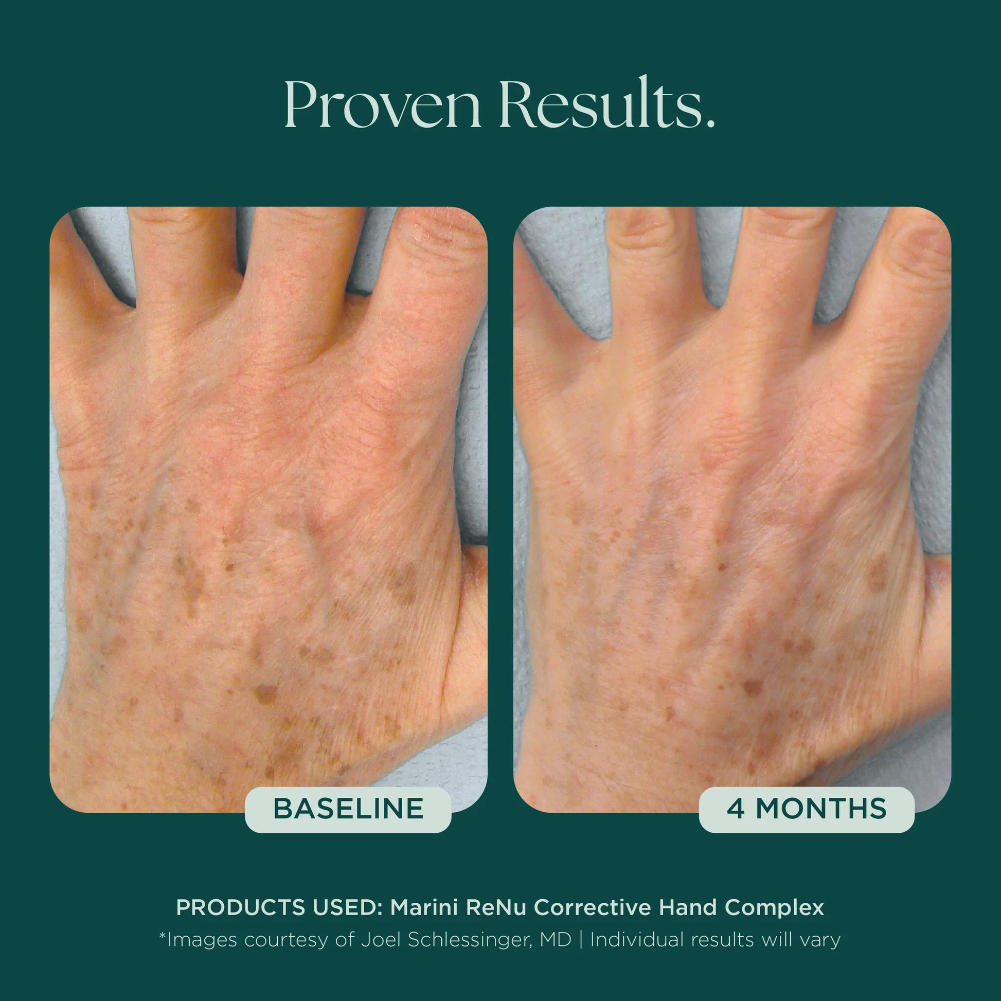 ReNu Corrective Hand Complex