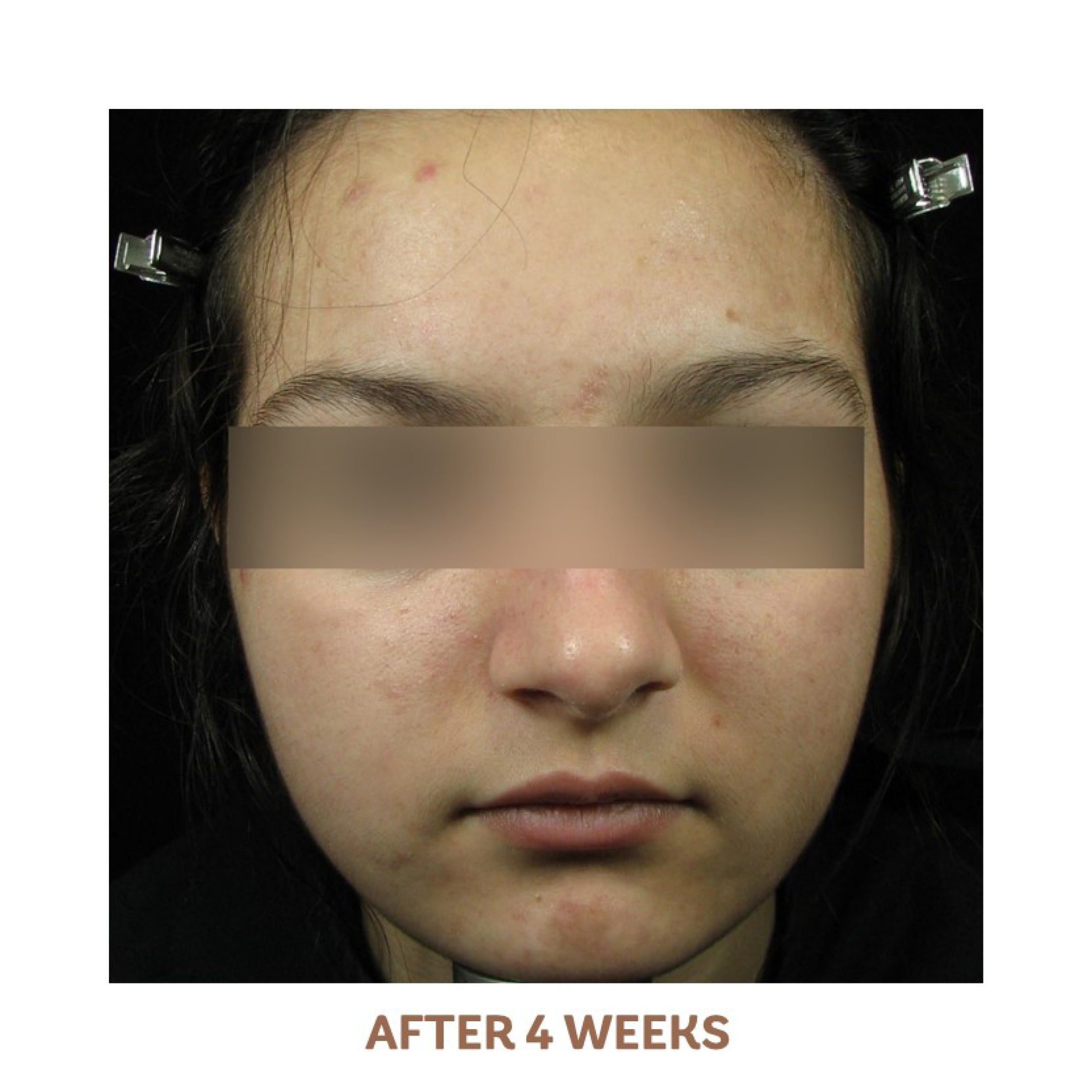 Acne Treatment System