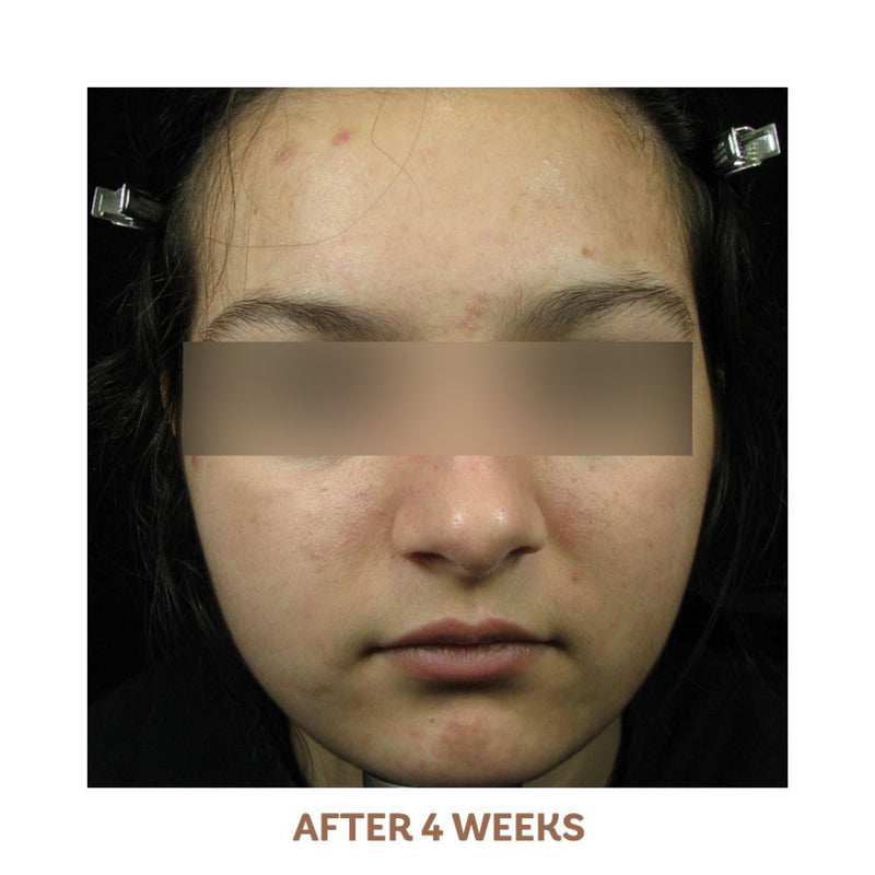 Acne Treatment System
