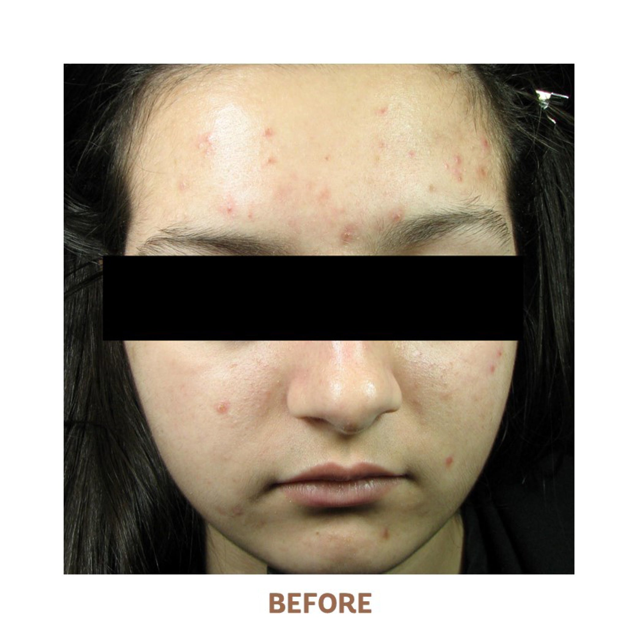 Acne Treatment System