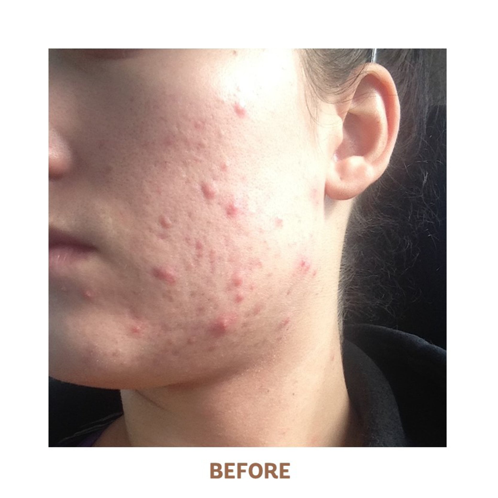 vivier aha bha exfoliating cream before