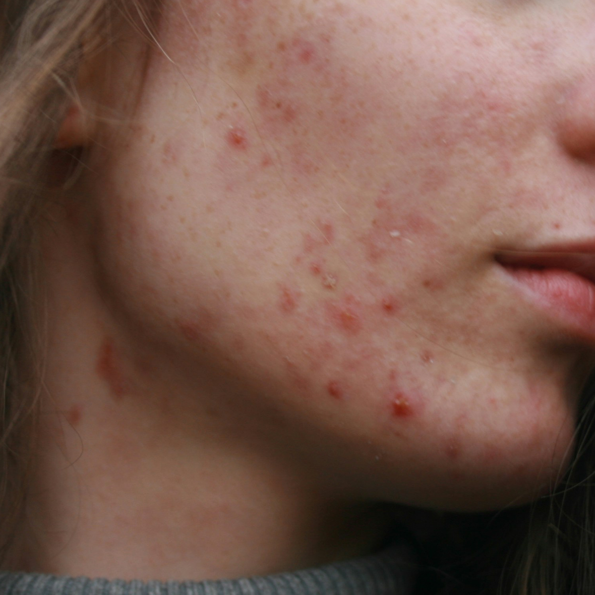Fungal Acne... What to do?