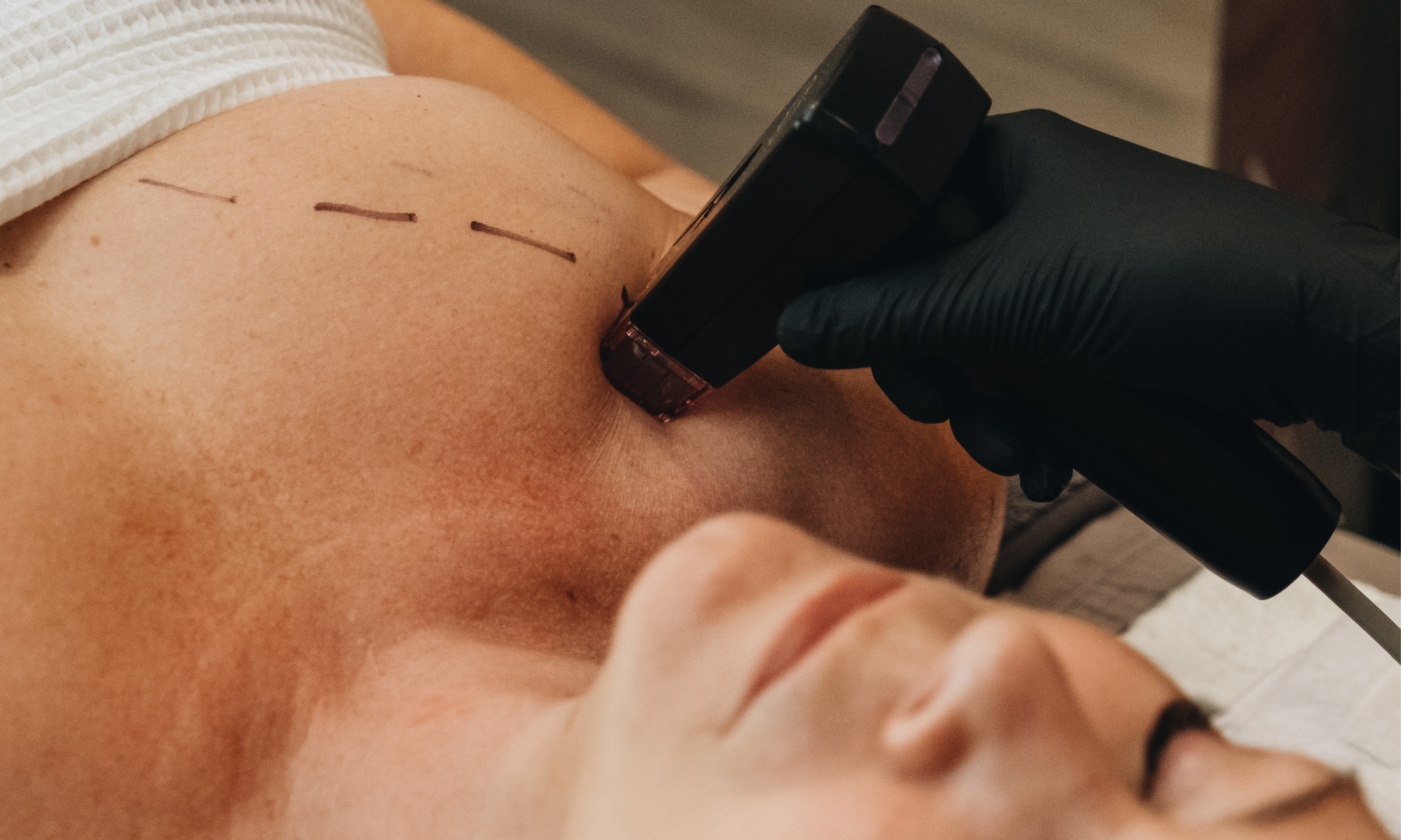 Treatments You Should Avoid During the Summer Months