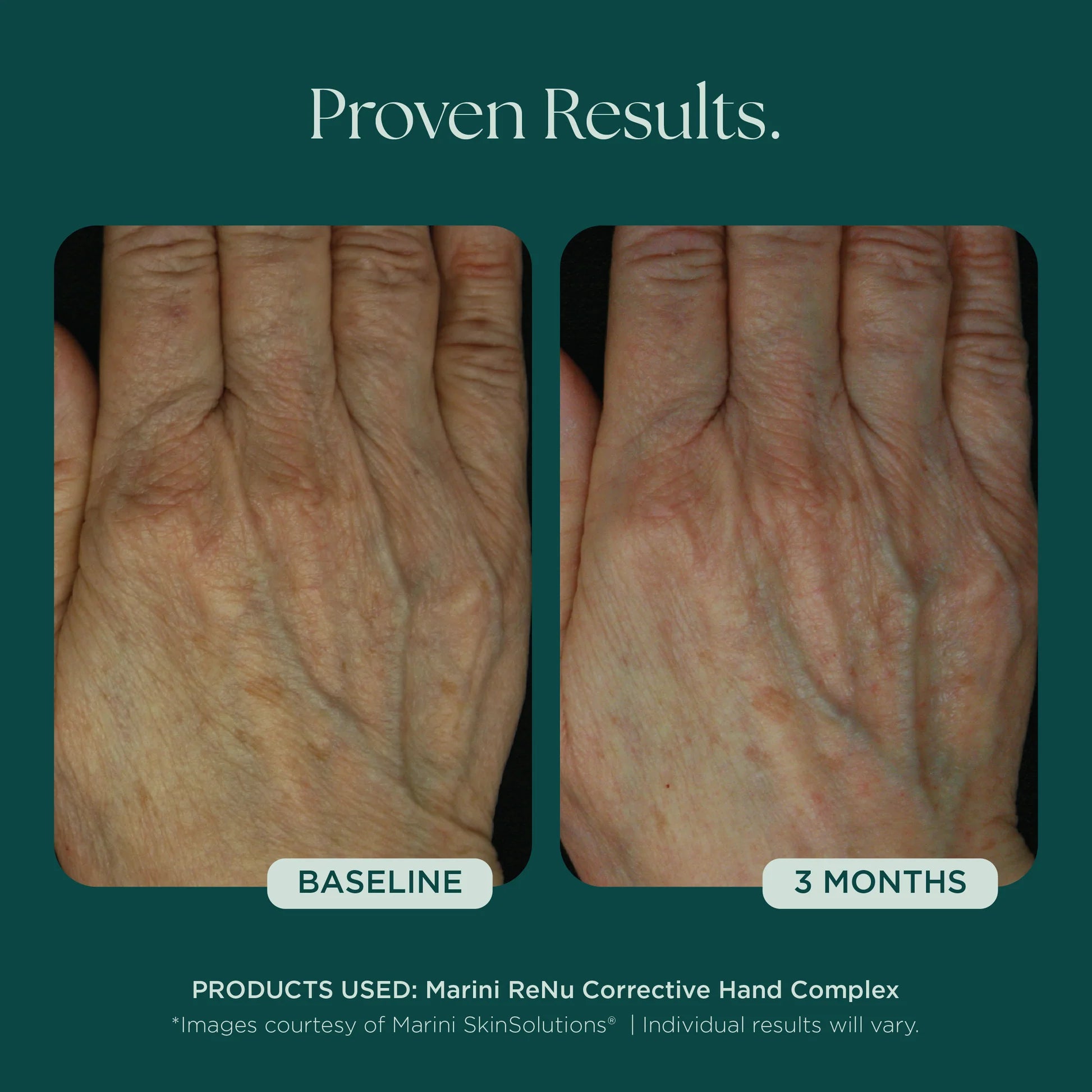 ReNu Corrective Hand Complex