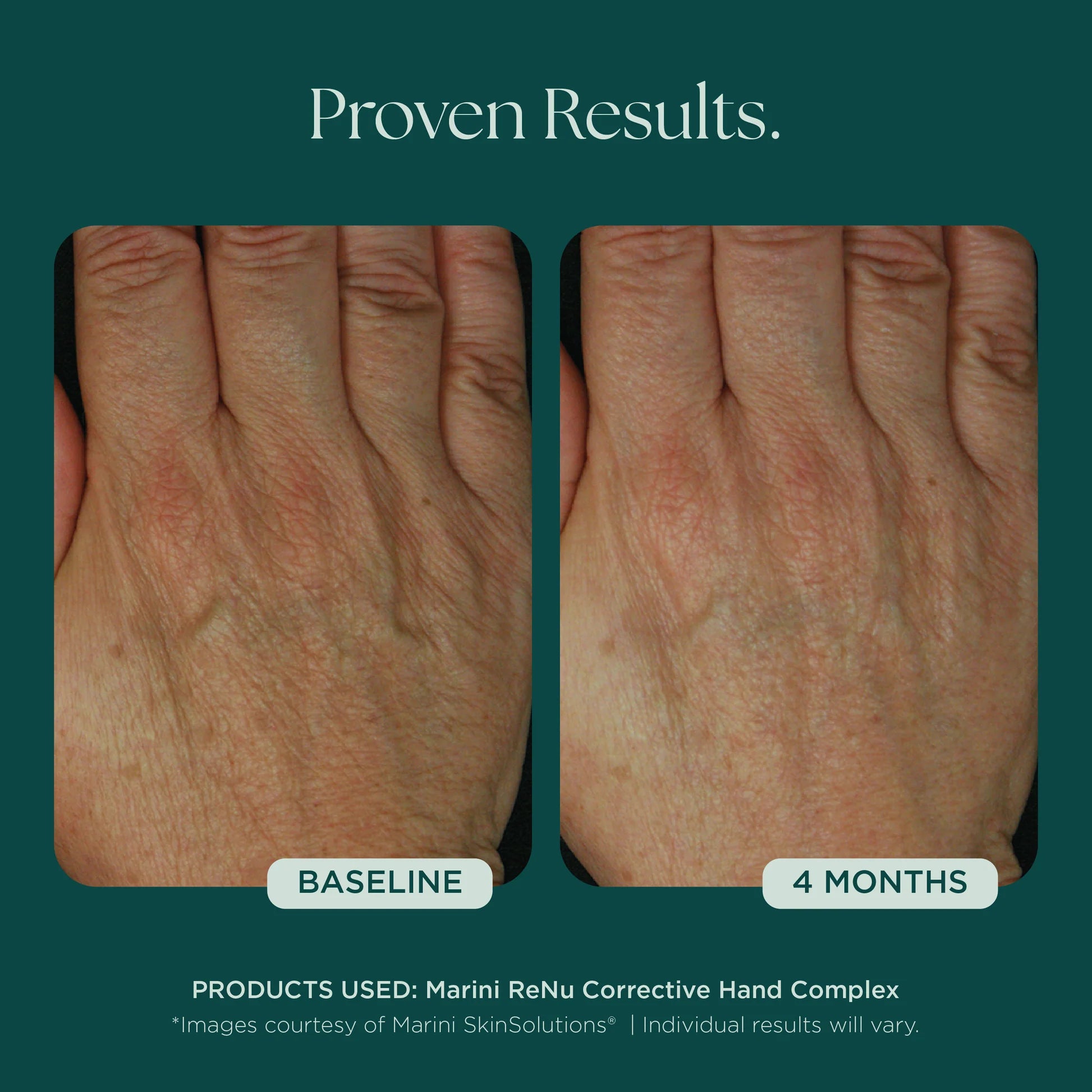 ReNu Corrective Hand Complex