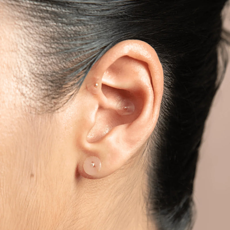 Acupressure ear seeds applied on ear for anxiety relief