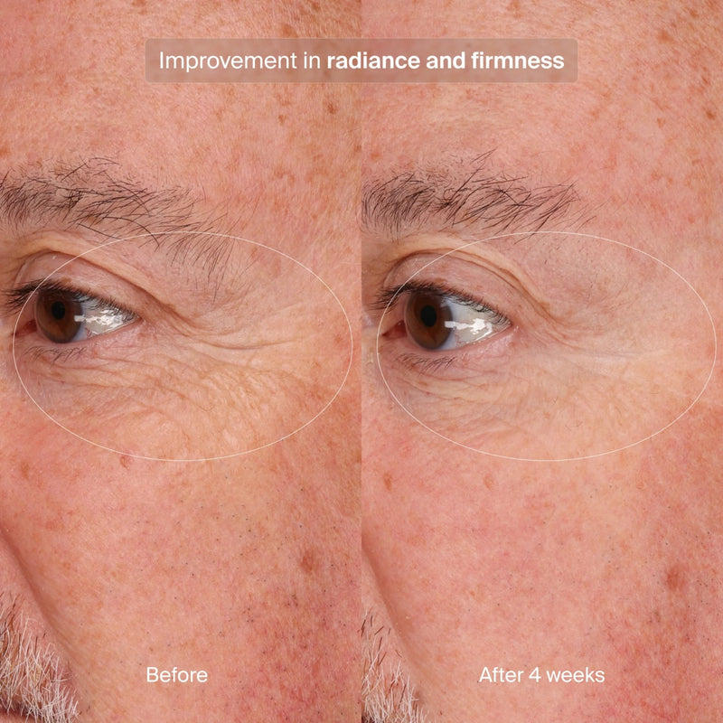 pavise-precision-eye-lift-1