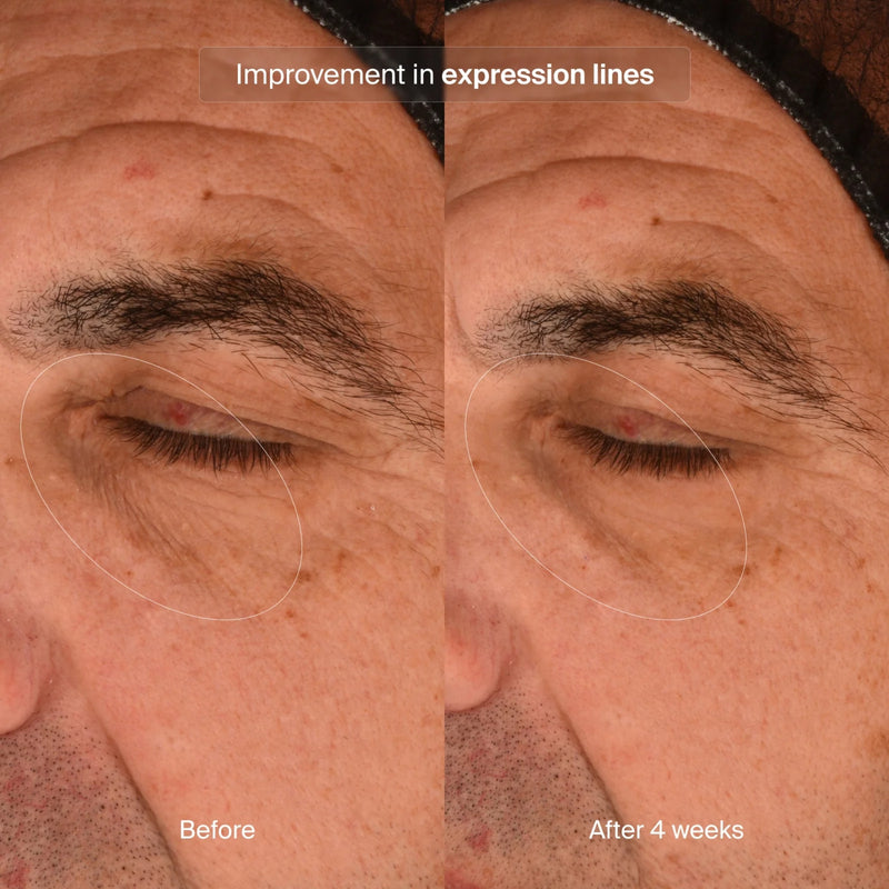 pavise-precision-eye-lift-1