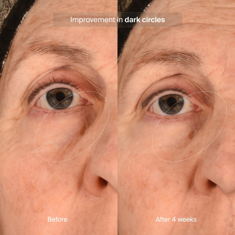 pavise-precision-eye-lift-1