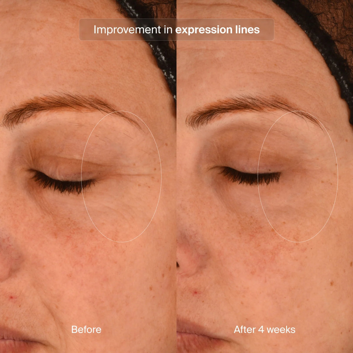 pavise-precision-eye-lift-1