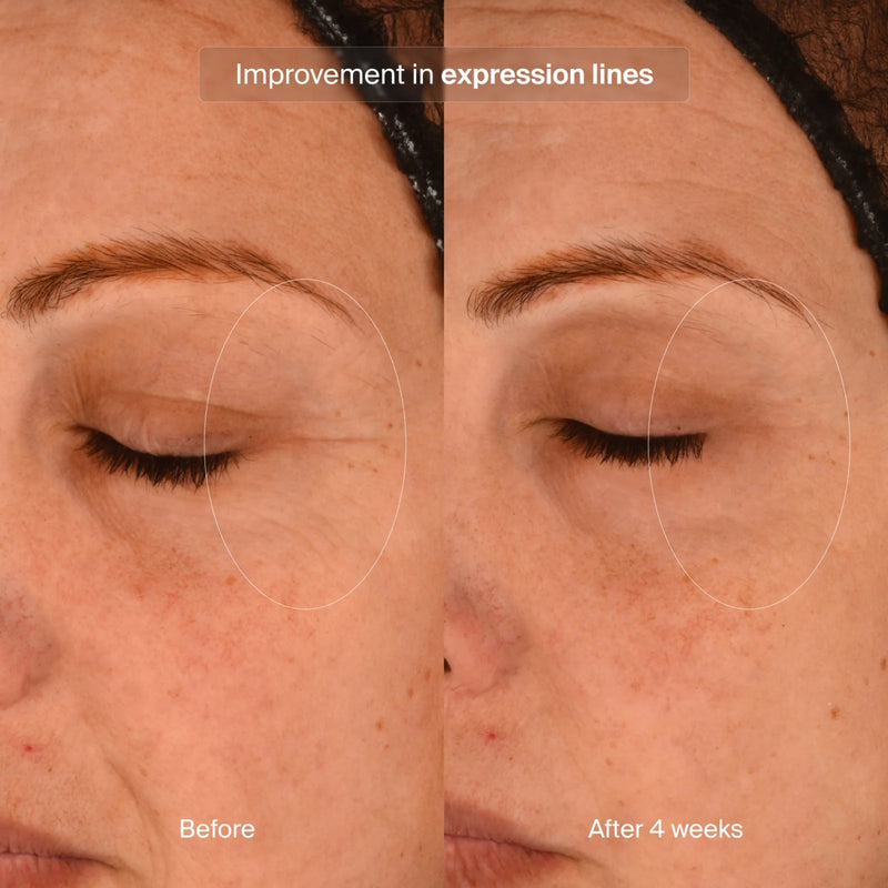 pavise-precision-eye-lift-1