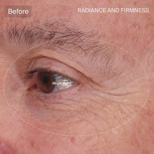 Precision Eye Lift