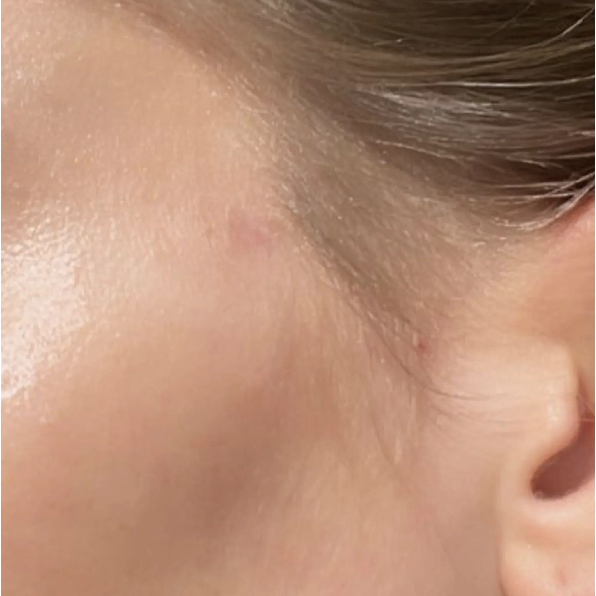 Scar Concentrate
