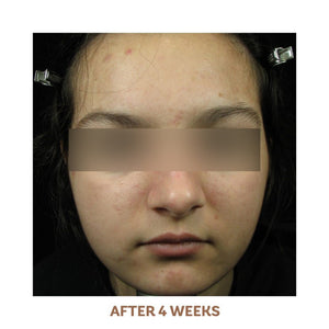 Acne Treatment System