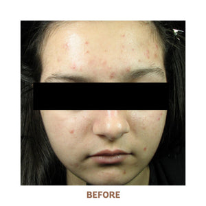 Acne Treatment System